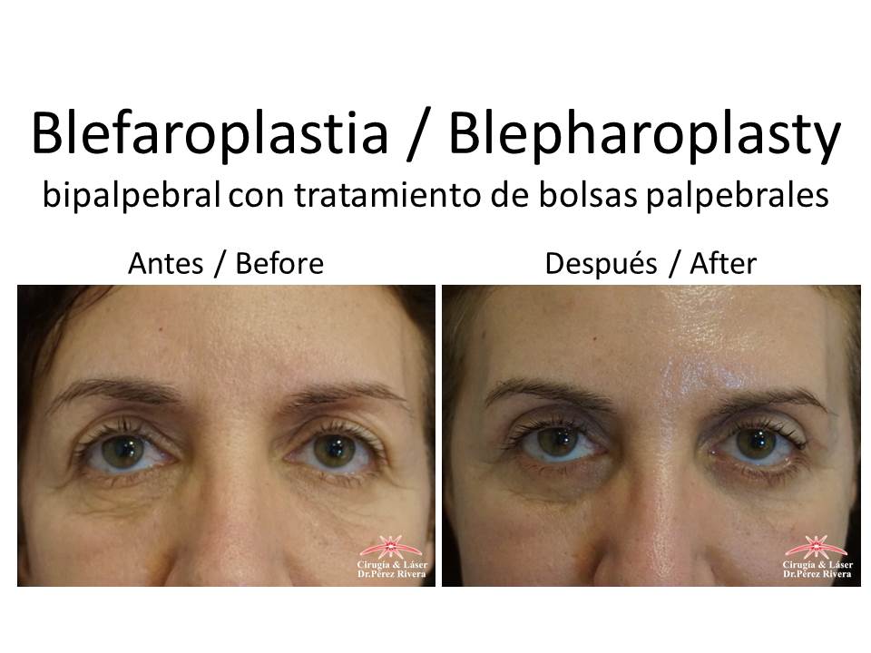 Antes y después