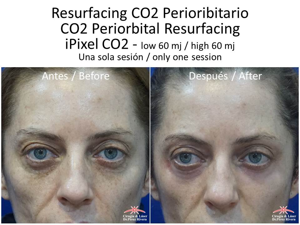 Antes y después