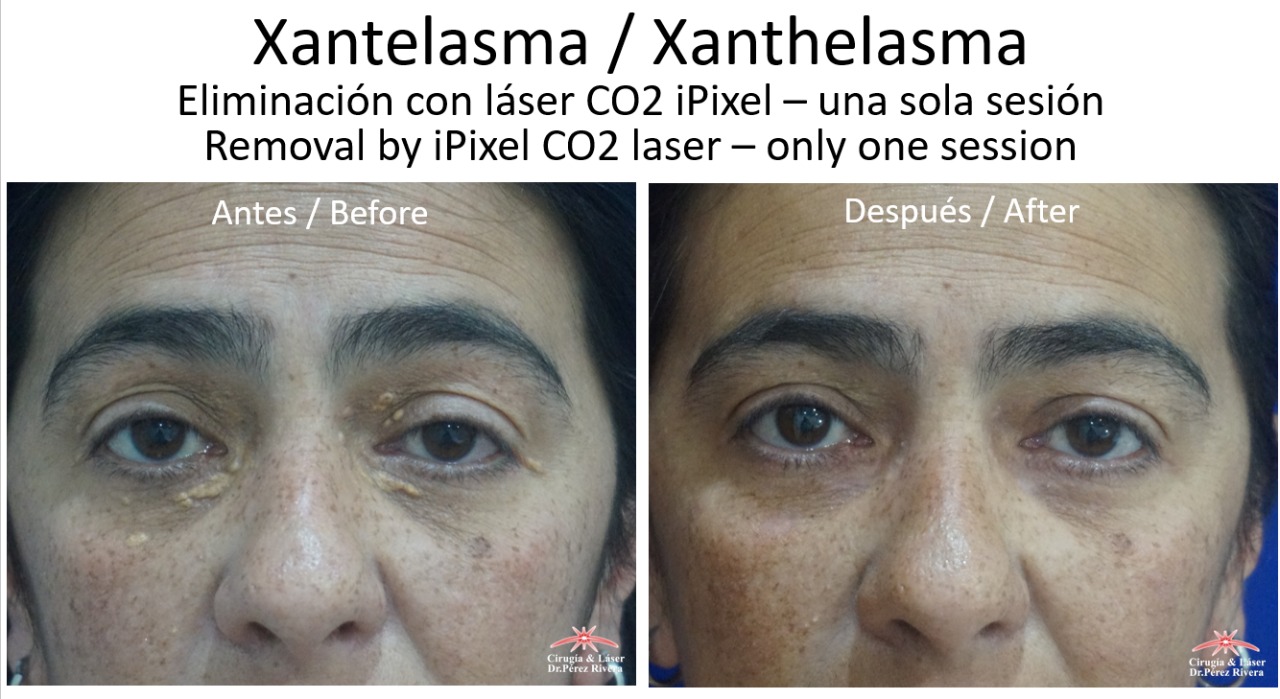 Antes y después