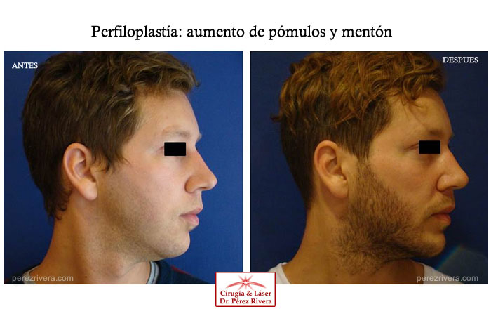 Antes y después
