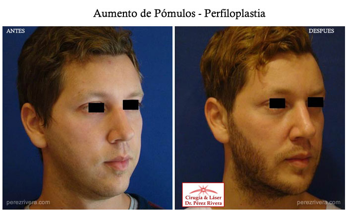 Antes y después