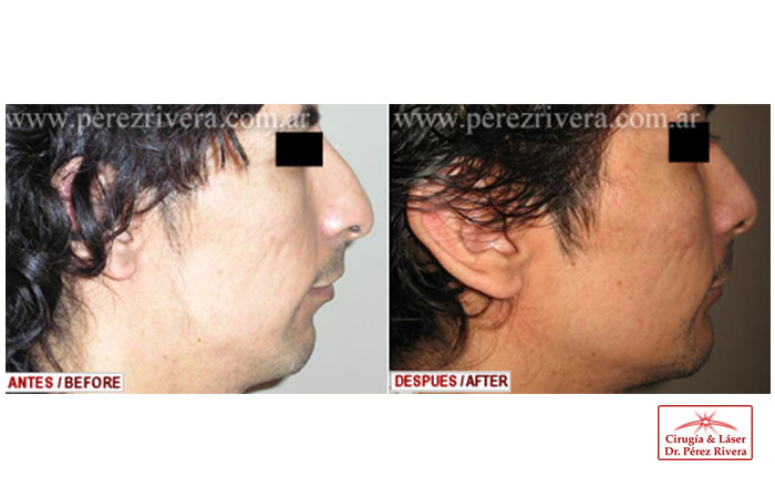 Antes y después