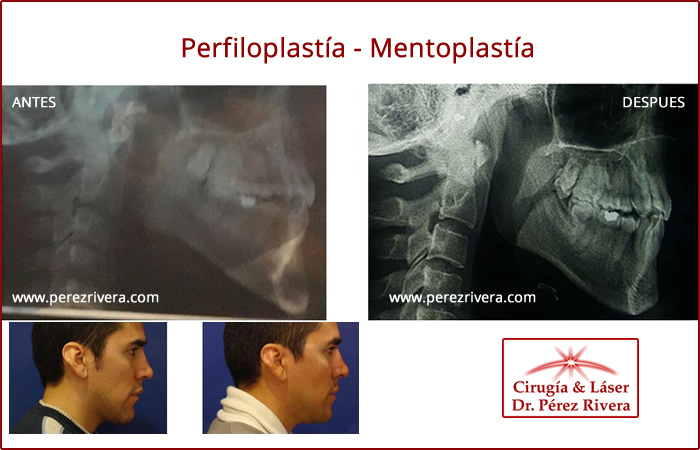 Antes y después