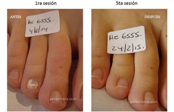 Antes y después