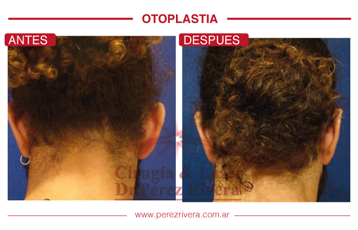 Antes y después