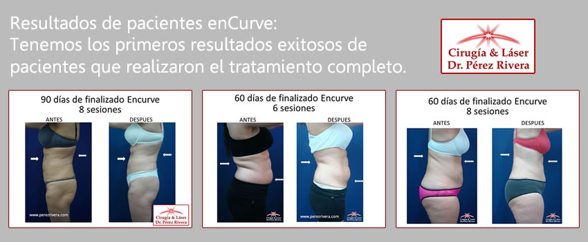 Resultados de pacientes enCurve: fotos y videos