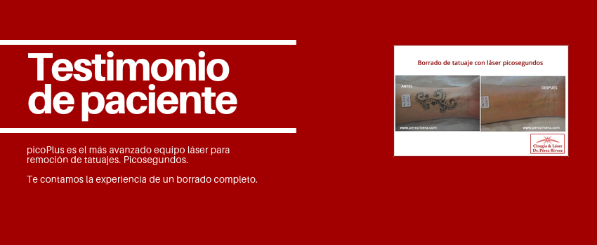 Testimonio de una paciente de borrado de tatuaje